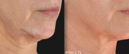 Genius® RF Microneedling Before and After Photo 8