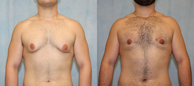 Male Gynecomastia Patient 6 Image 0