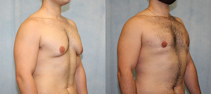 Male Gynecomastia Patient 6 Image 2