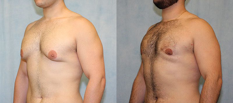 Male Gynecomastia Patient 6 Image 1