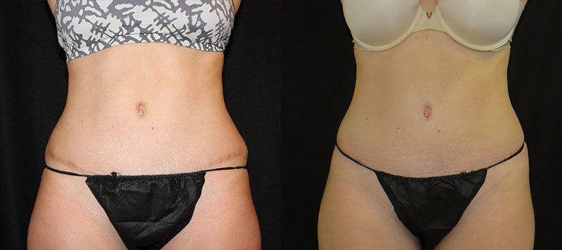 CoolSculpting Patient 2 Image 0