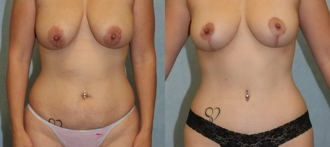 Breast Lift Patient 5 Image 7