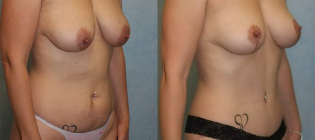 Breast Lift Patient 5 Image 6