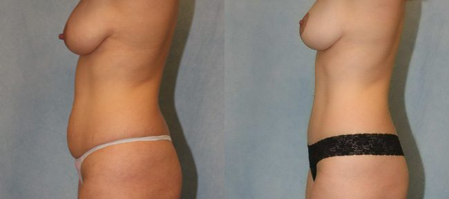 Breast Lift Patient 5 Image 1