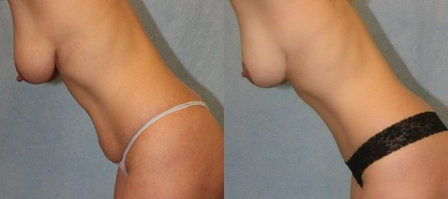 Breast Lift Patient 5 Image 0