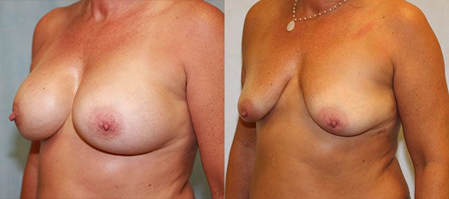 Breast Removal Implant Patient 1 Image 0