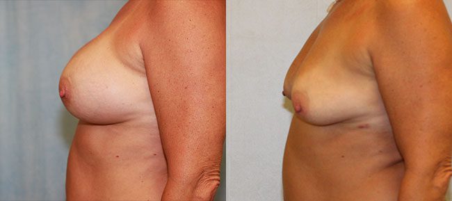 Breast Removal Implant Patient 1 Image 2
