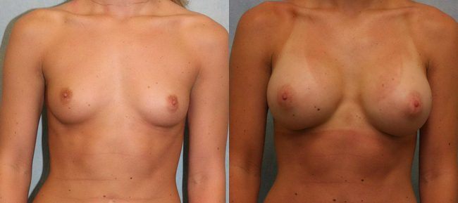 Breast Augmentation Patient 15 Image 4