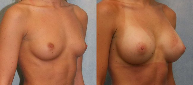 Breast Augmentation Patient 15 Image 3