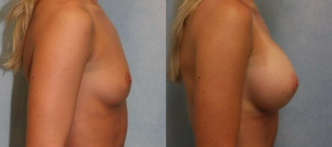 Breast Augmentation Patient 15 Image 2