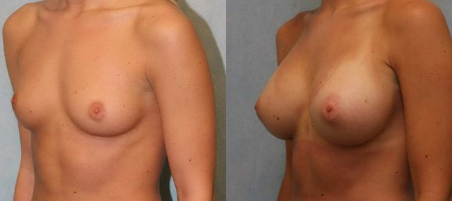 Breast Augmentation Patient 15 Image 1