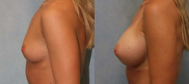 Breast Augmentation Patient 15 Image 0