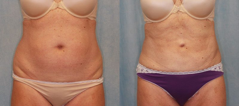 Liposuction Patient 7 Image 2