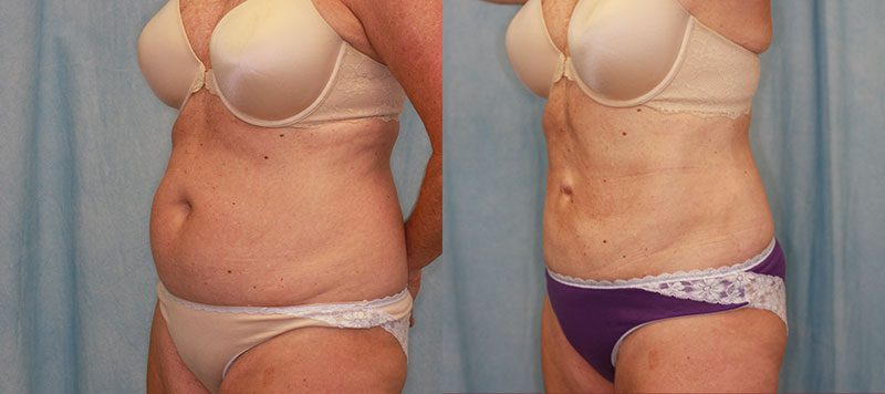 Liposuction Patient 7 Image 1