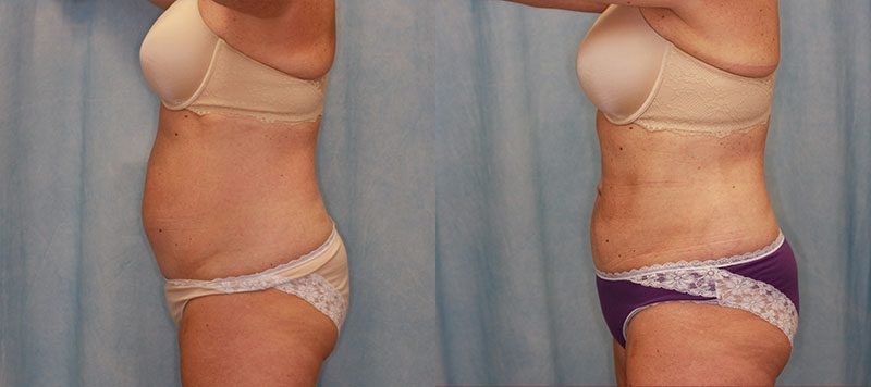 Liposuction Patient 7 Image 0