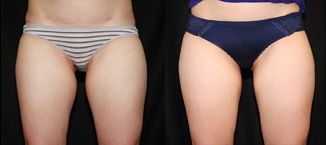 CoolSculpting Patient 8 Image 0