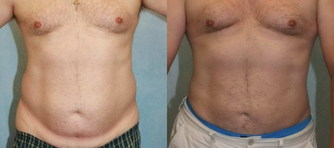 Liposuction Patient 1 Image 4