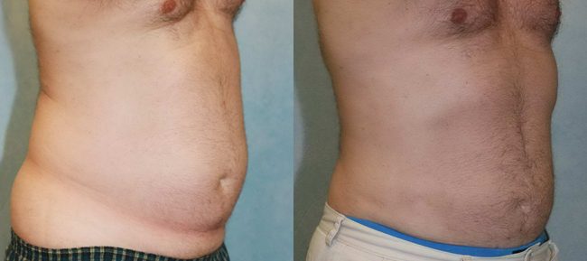 Liposuction Patient 1 Image 3