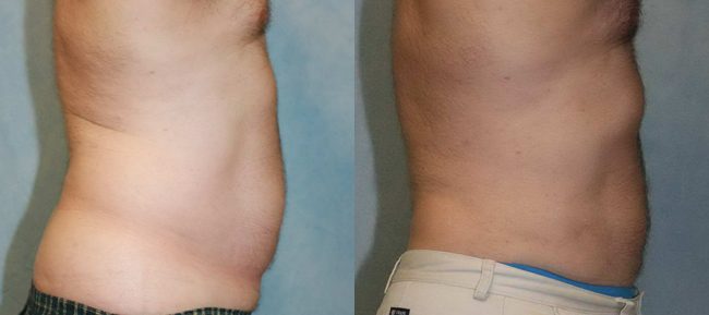 Liposuction Patient 1 Image 2