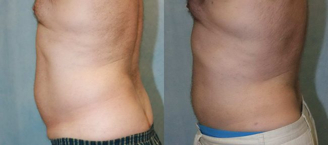 Liposuction Patient 1 Image 1