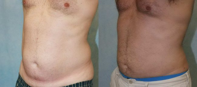 Liposuction Patient 1 Image 0