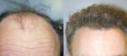 NeoGraft® Before and After Photo 0