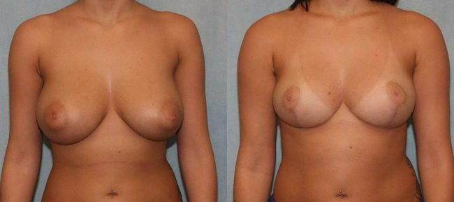 Breast Reduction Patient 3 Image 4