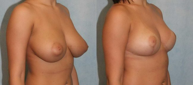 Breast Reduction Patient 3 Image 3