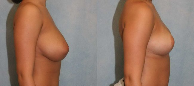 Breast Reduction Patient 3 Image 2