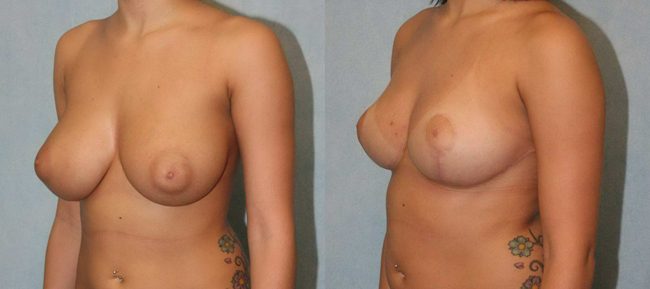 Breast Reduction Patient 3 Image 1