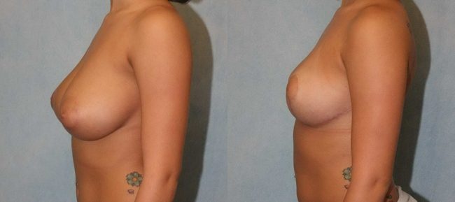 Breast Reduction Patient 1398 Image 0
