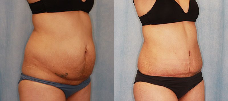 Abdominoplasty Patient 17 Image 3