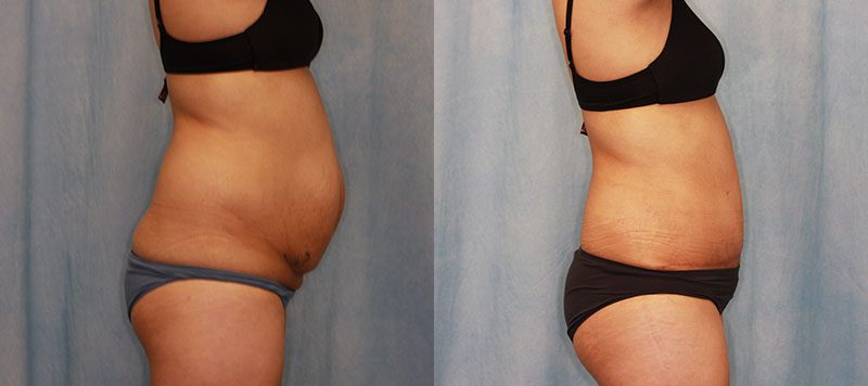 Abdominoplasty Patient 17 Image 2