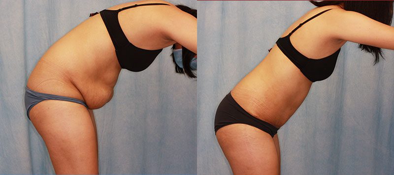 Abdominoplasty Patient 17 Image 1