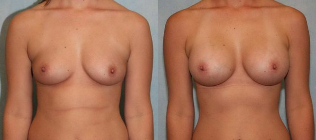 Breast Augmentation Patient 11 Image 4