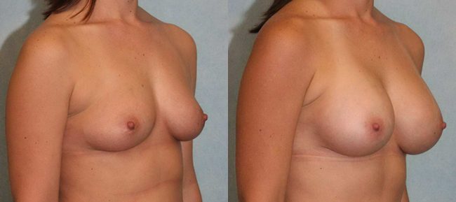 Breast Augmentation Patient 11 Image 3