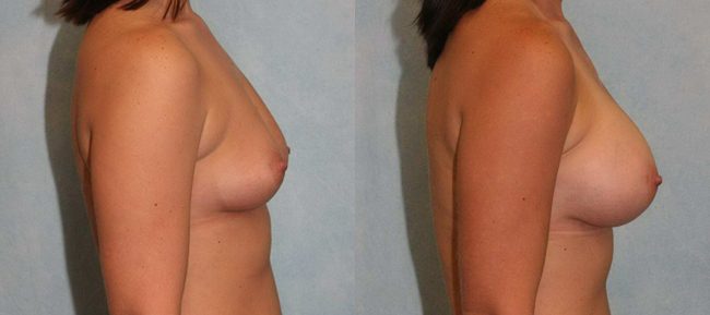 Breast Augmentation Patient 11 Image 2