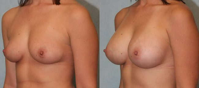 Breast Augmentation Patient 11 Image 1