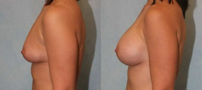 Breast Augmentation Patient 11 Image 0