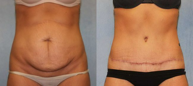 Abdominoplasty Patient 10 Image 5