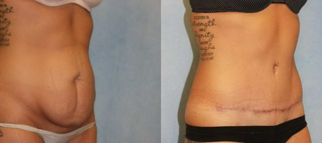 Abdominoplasty Patient 10 Image 4