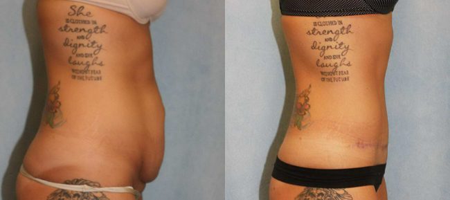 Abdominoplasty Patient 10 Image 3