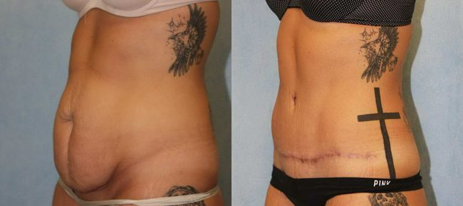 Abdominoplasty Patient 10 Image 2