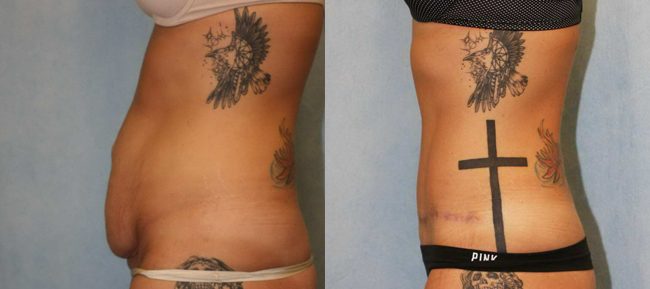 Abdominoplasty Patient 10 Image 1