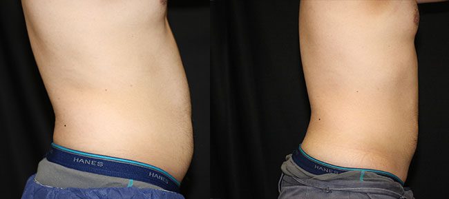 CoolSculpting Patient 10 Image 0