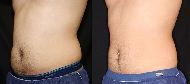 CoolSculpting Patient 10 Image 1