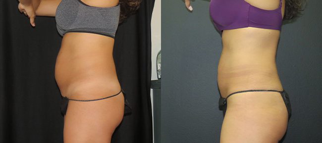 CoolSculpting Patient 5 Image 0