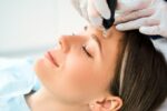 The Major Benefits Of RF Microneedling