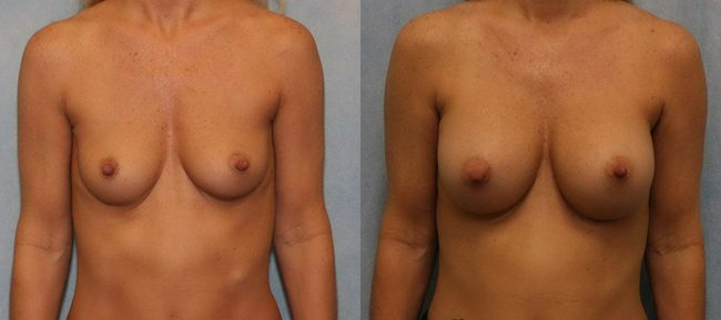 Breast Augmentation Patient 9 Image 4