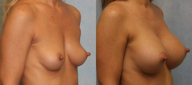 Breast Augmentation Patient 9 Image 3